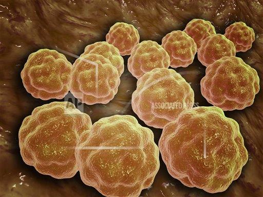Health officials confirm measles case on Kenai Peninsula